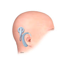 Nutec e Nuface dão primeiro passo para confecção de prótese auricular personalizada